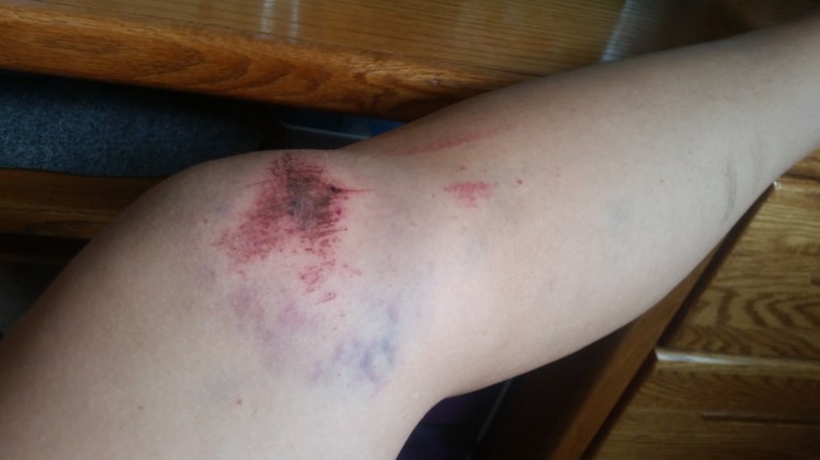 My first trail-running fall! 